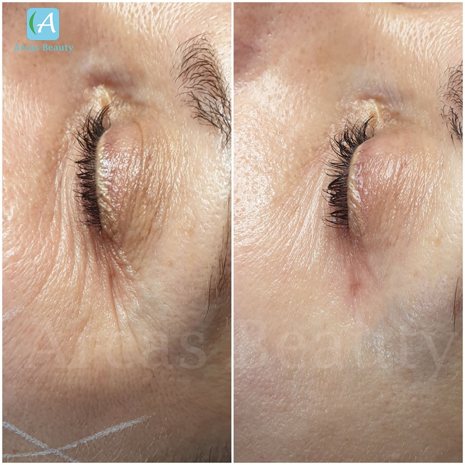 Facial rejuvenation after 40 years: What to offer the client?