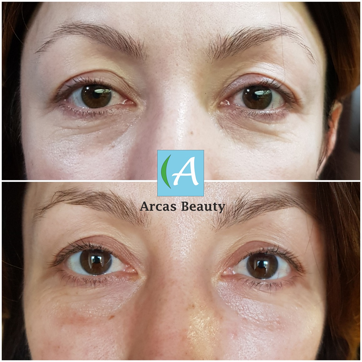 How to remove nasolacrimal without filler